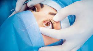 صحة دهوك : العمل بجهاز ليزري الكترونيا في عمليات العيون بدهوك