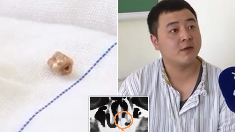 حالة نادرة من نوعها رجل صيني يكتشف سنًا نما داخل أنفه لمدة 20 عامًا